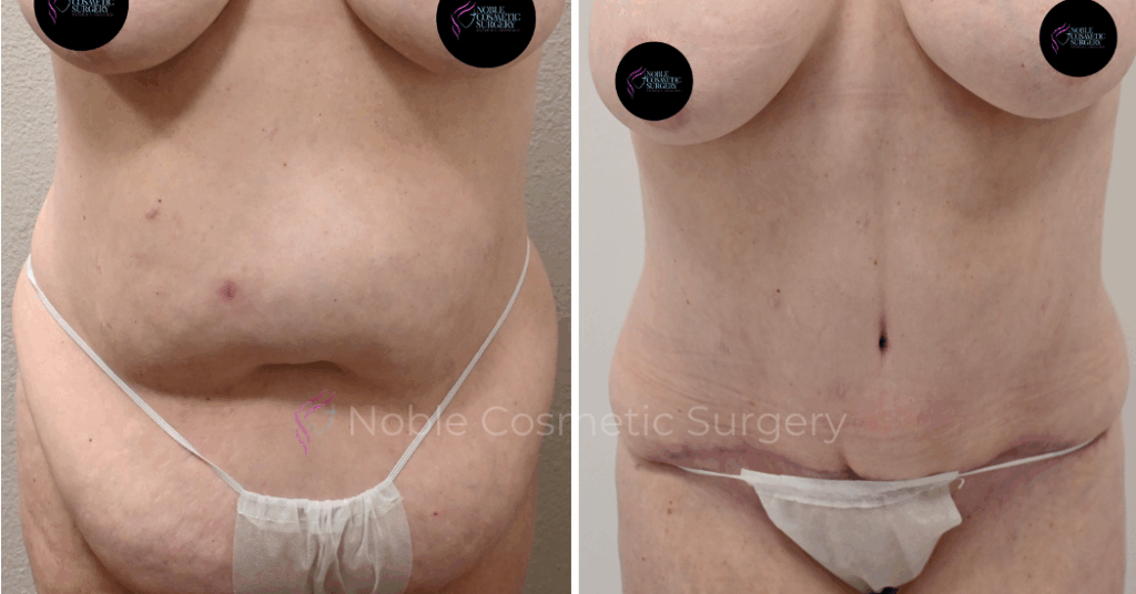 TUMMY TUCK CASE 00039