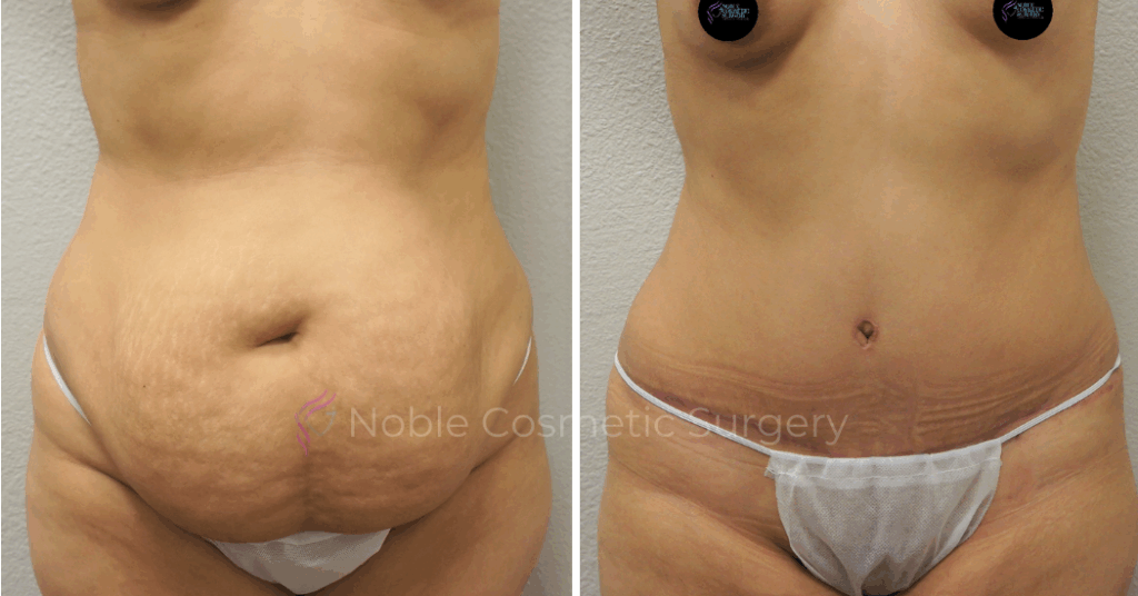 TUMMY TUCK CASE 00048