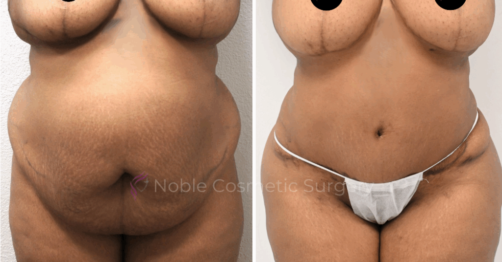 TUMMY TUCK CASE 00038
