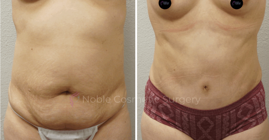 TUMMY TUCK CASE 00049