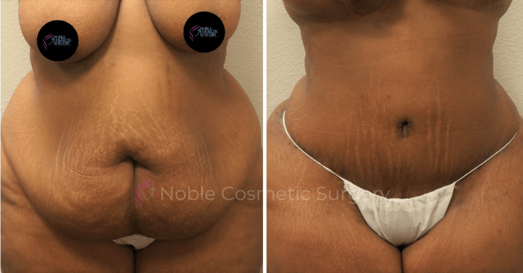 TUMMY TUCK CASE 00051