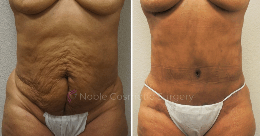 TUMMY TUCK CASE 00052