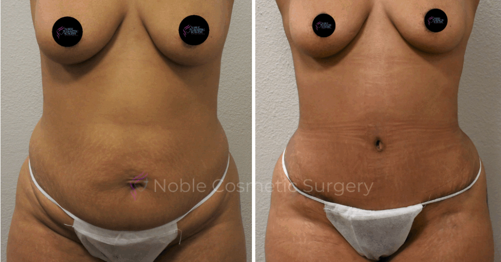 TUMMY TUCK CASE 00040