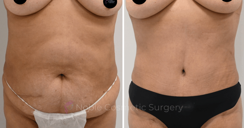 TUMMY TUCK CASE 00324