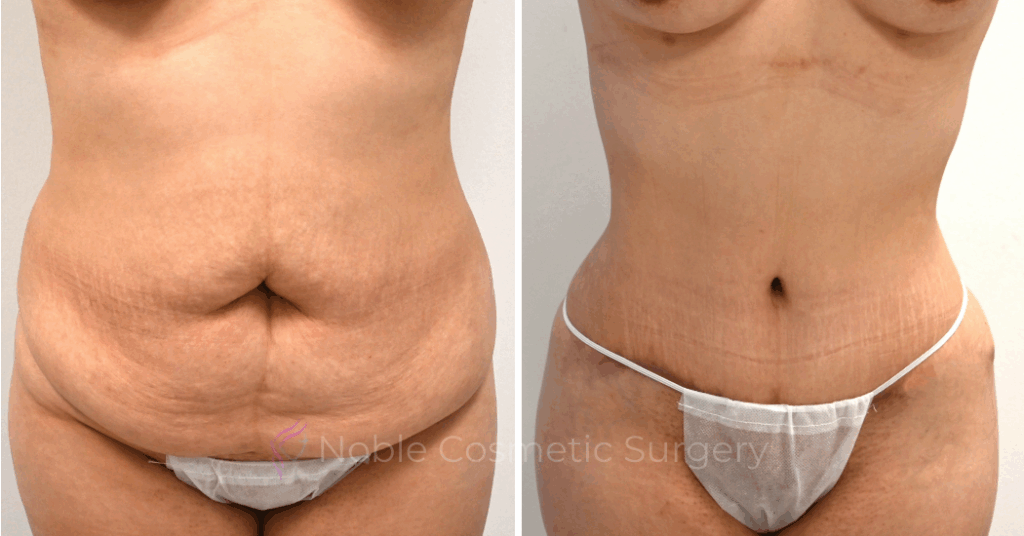 TUMMY TUCK CASE 00325