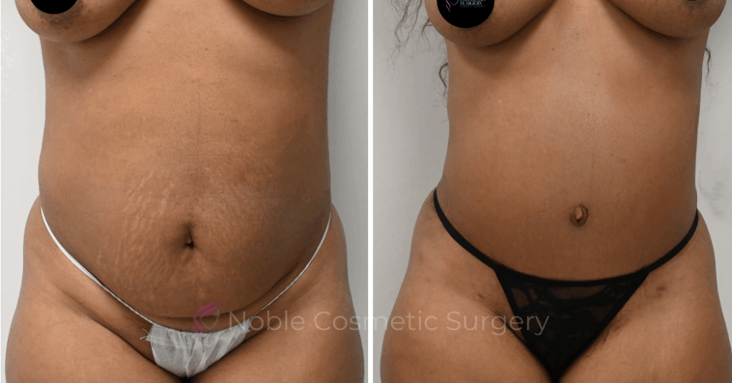 TUMMY TUCK CASE 00326