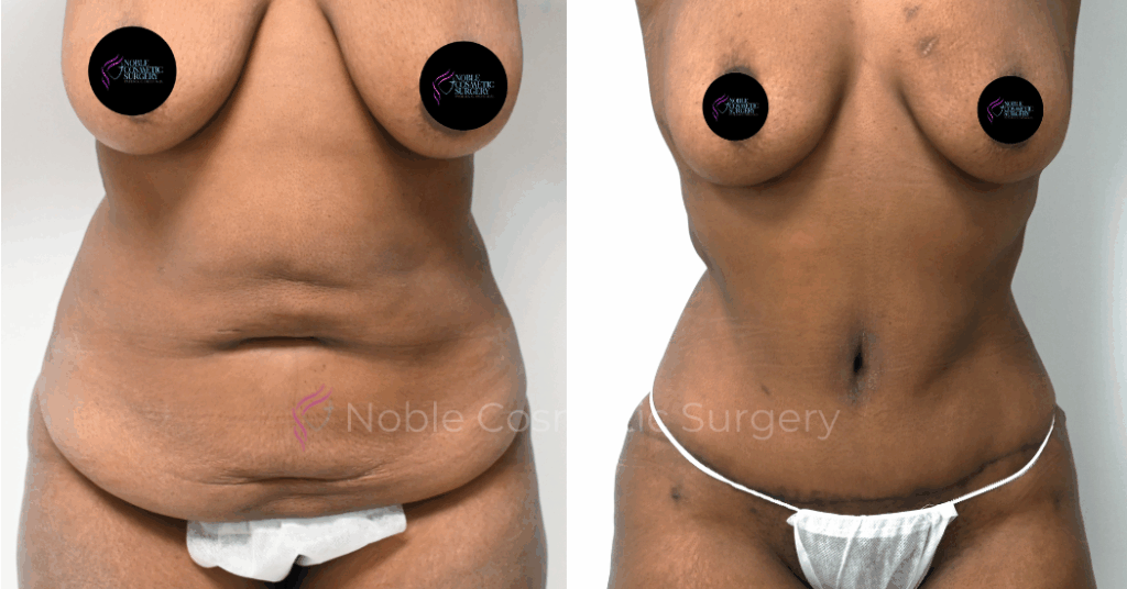 TUMMY TUCK CASE 10784