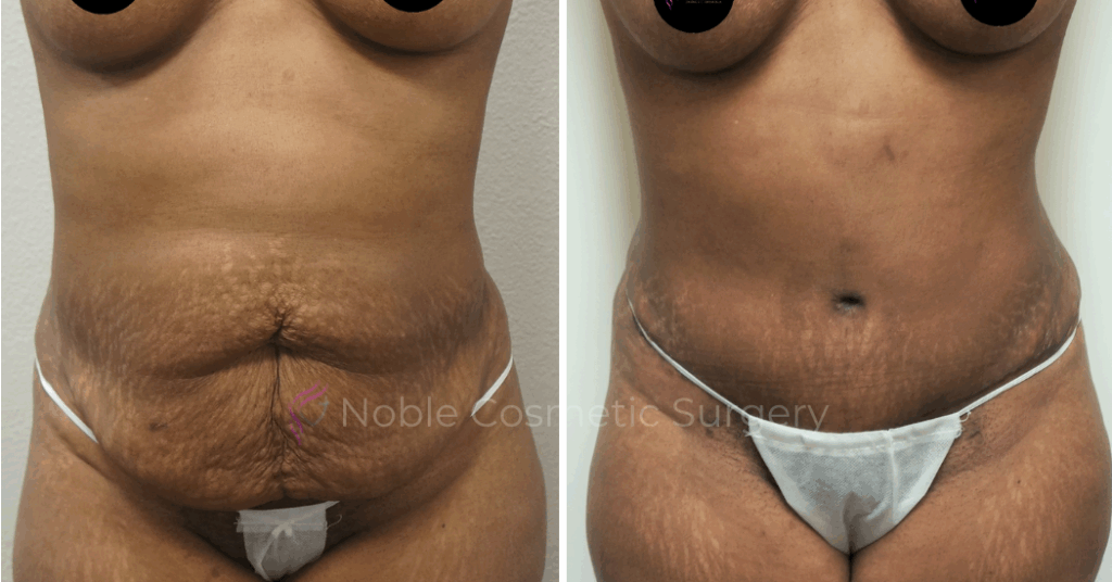 TUMMY TUCK CASE 00041