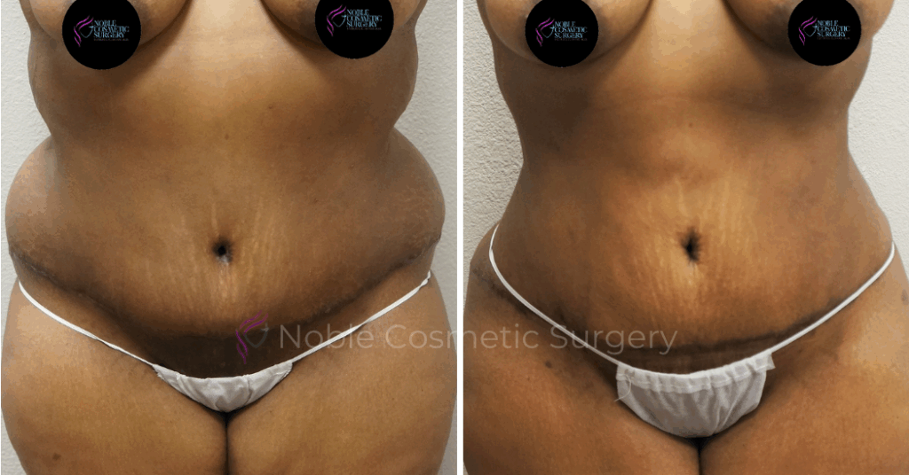 TUMMY TUCK CASE 00042