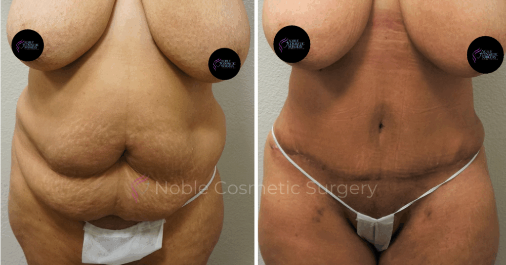TUMMY TUCK CASE 00043