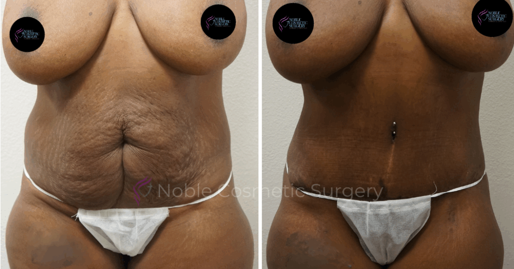 TUMMY TUCK CASE 00044
