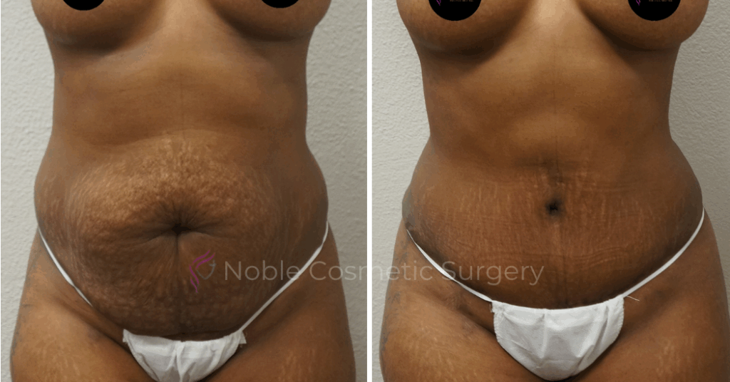 TUMMY TUCK CASE 00046