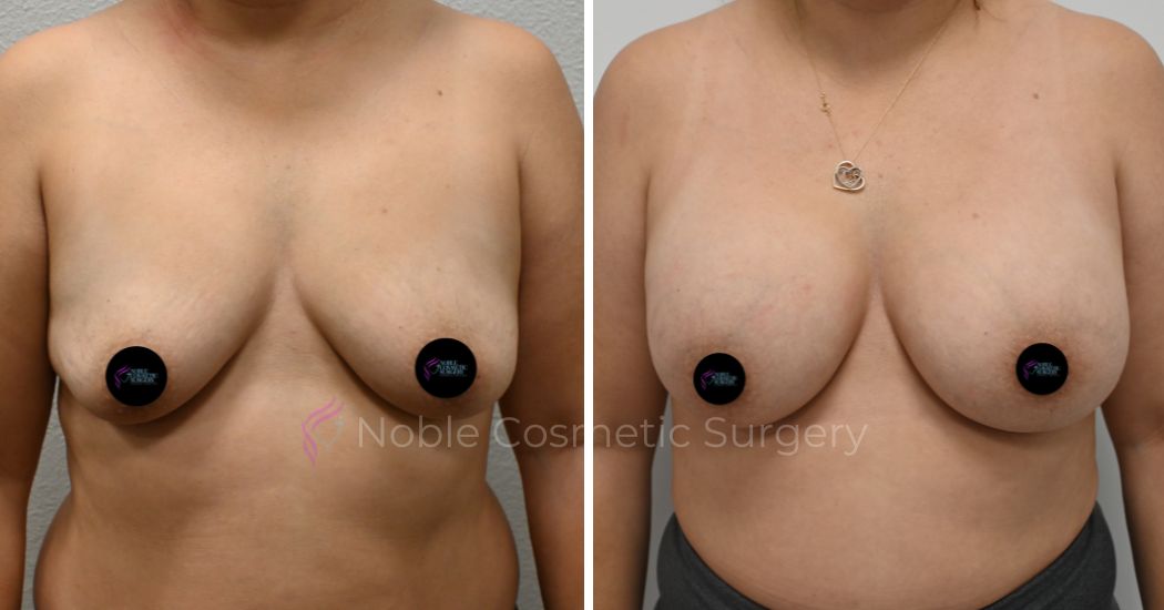 P1-15207 | Before and After Breast Augmentation 1