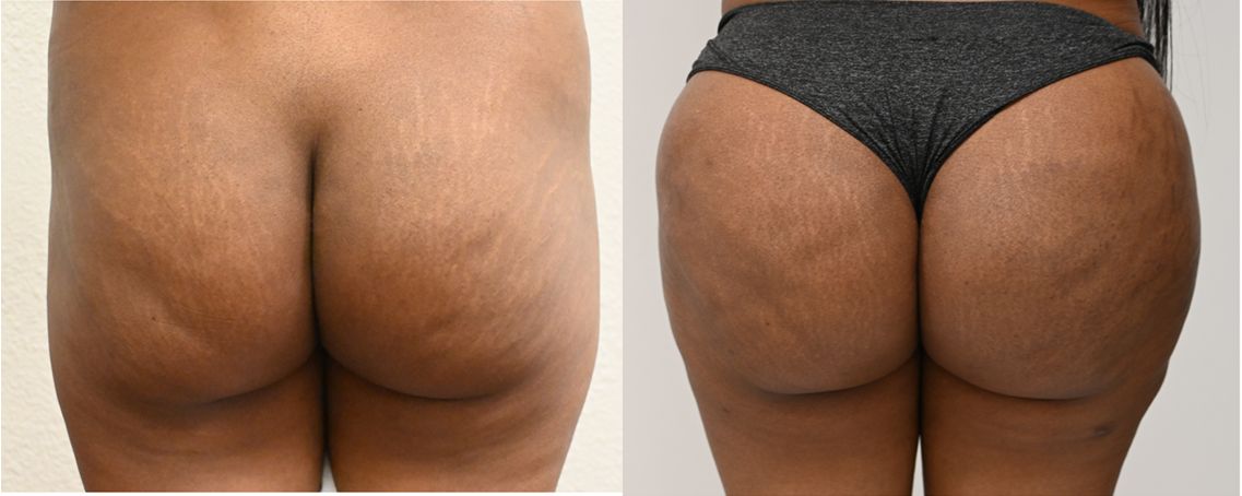 P2-00901-BBL | Before and After Brazilian Butt Lift 1