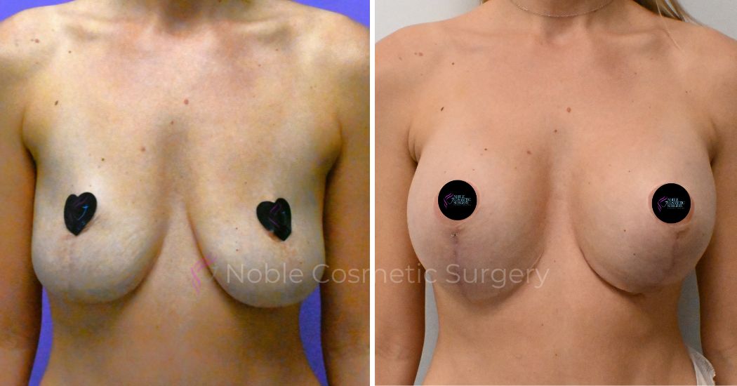 P2-19511 | Before and After Breast Augmentation with Lift 1