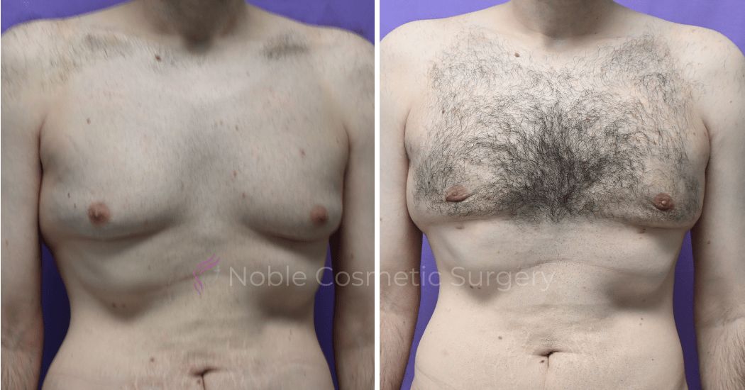 P3-19647 | Before and After Men