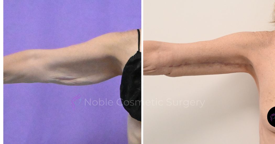 P2-20003 | Before and After Brachioplasty 1