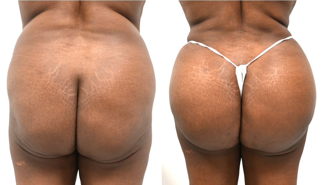 P3-00902-BBL | Before and After Brazilian Butt Lift 1