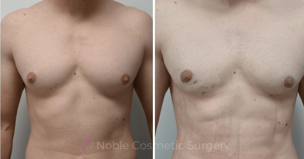 P3-17230 | Before and After Men