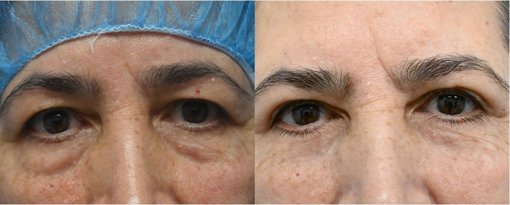 P3-19865 | Before and After Blepharoplasty 1