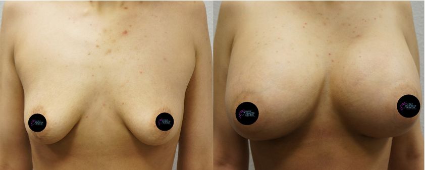 P4-00056 | Before and After Breast Augmentation 1