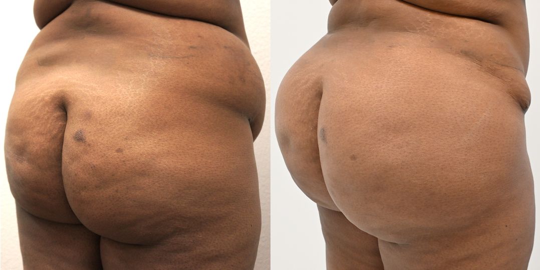 P4-00903-BBL | Before and After Brazilian Butt Lift 1