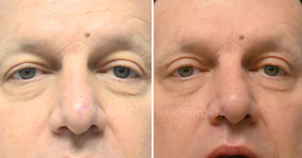 P4-19638 | Before and After Blepharoplasty 1