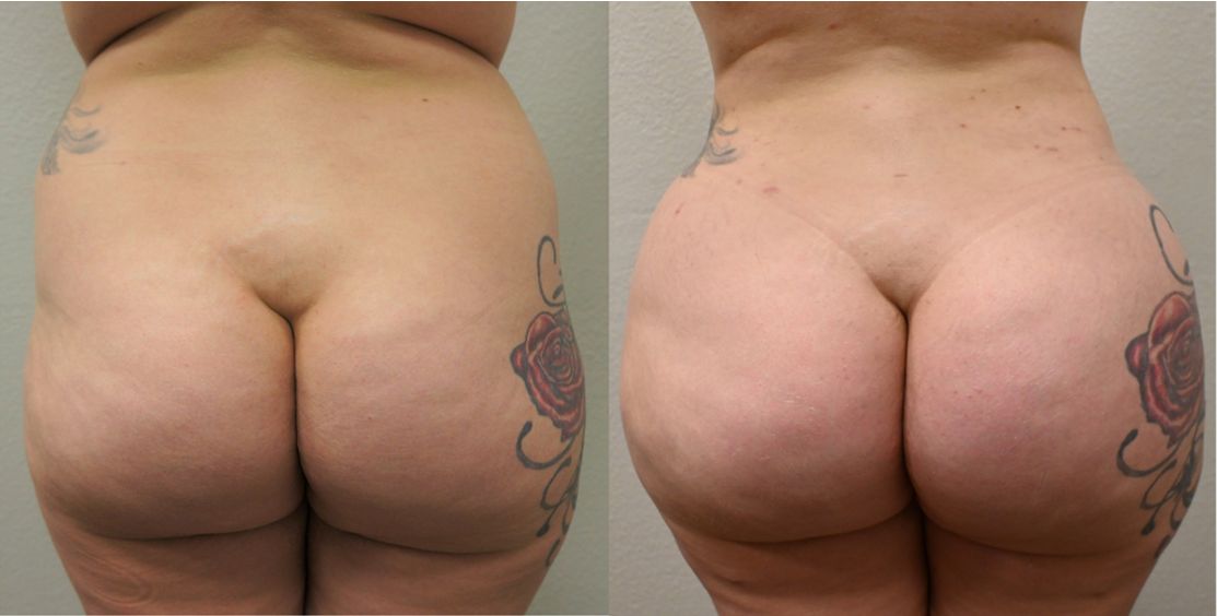 P5-00904-BBL | Before and After Brazilian Butt Lift 1