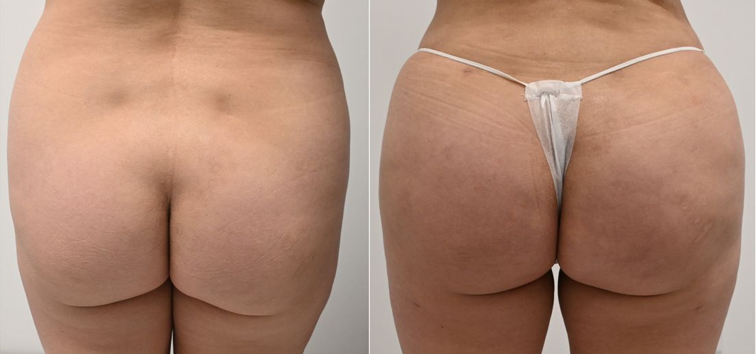 P6-00905-BBL | Before and After Brazilian Butt Lift 1