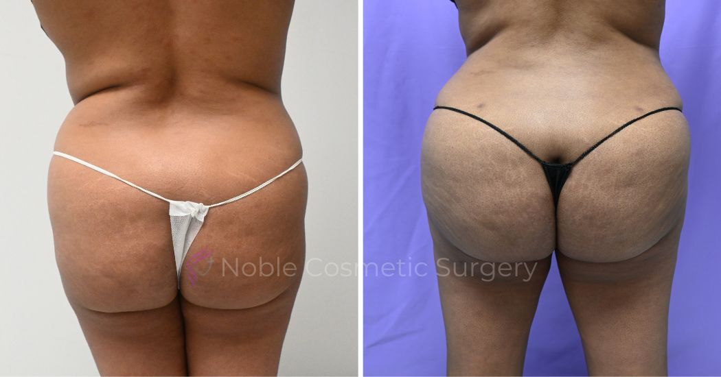 P7-00906-BBL | Before and After Brazilian Butt Lift 1
