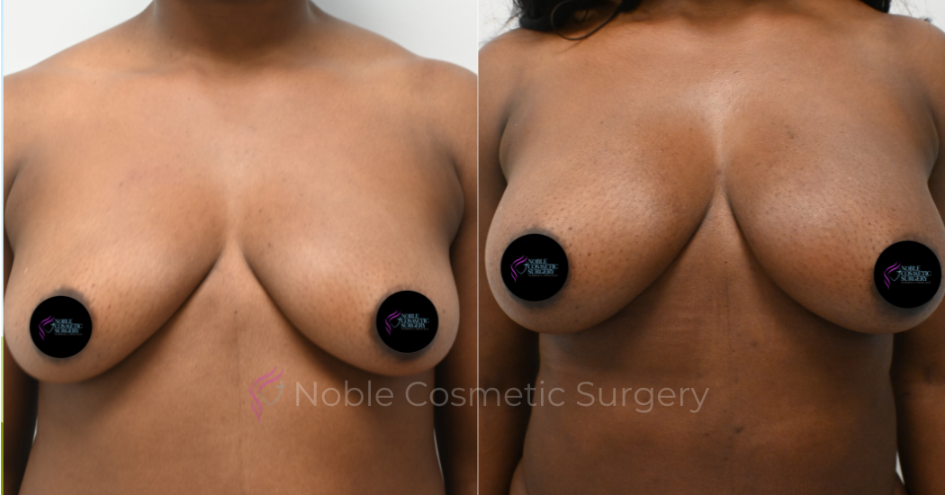 BREAST-AUGMENTATION--WITH-FAT-TRANSFER--CASE-10946 | Before and After Breast Augmentation 1