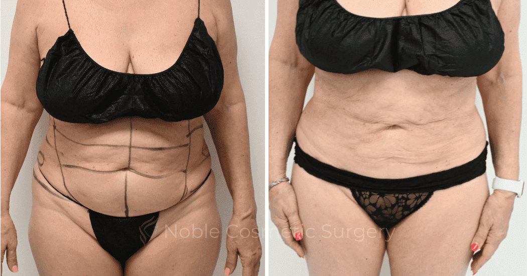 LIPOSUCTION-CASE-10145 | Before and After Liposuction 1