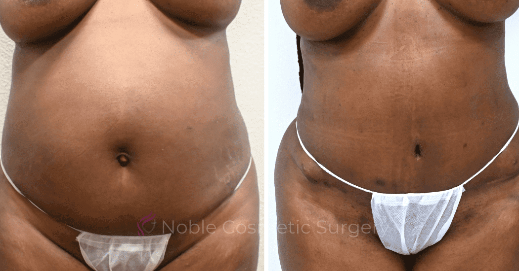 TUMMY-TUCK-CASE-13477 | Before and After Body