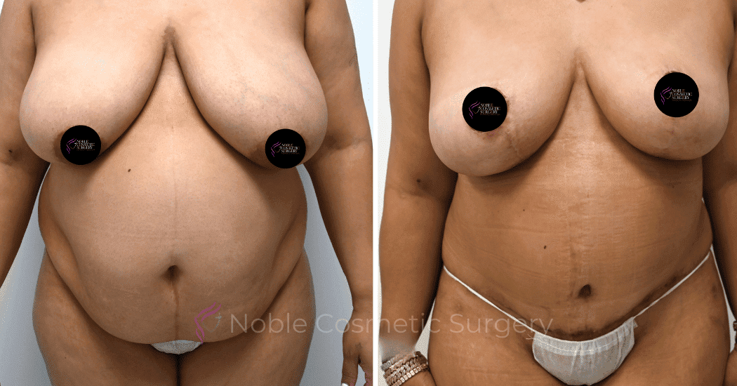 TUMMY-TUCK-CASE-11303 | Before and After Abdominoplasty 1