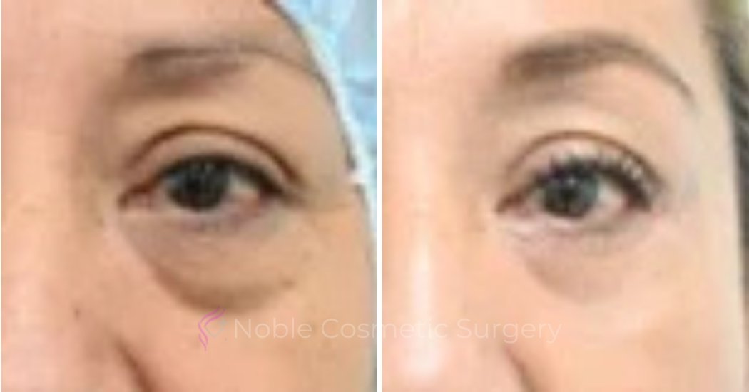 BLEPHAROPLASTY-CASE-00254 | Before and After Blepharoplasty 1