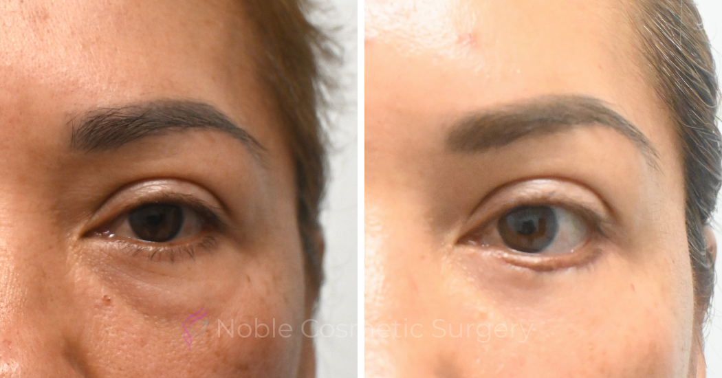 BLEPHAROPLASTY-CASE-19072 | Before and After Blepharoplasty 1