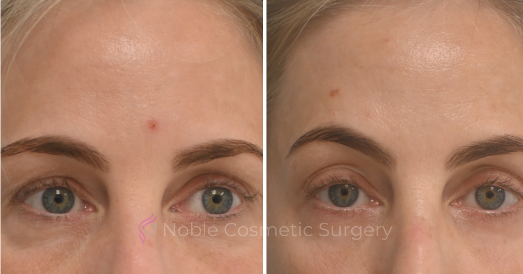 BLEPHAROPLASTY-CASE-10182 | Before and After Blepharoplasty 1