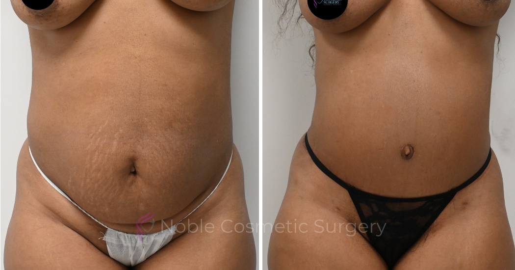 TUMMY-TUCK-CASE-00326 | Before and After Abdominoplasty 1