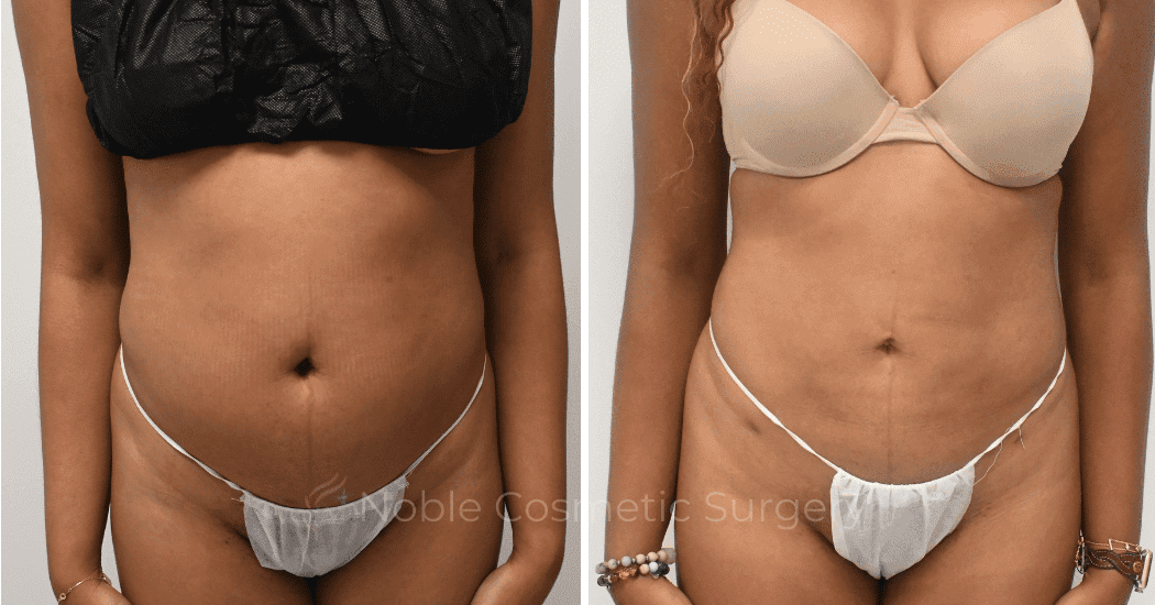 LIPOSUCTION-ABDOMEN-CASE--10533 | Before and After Body