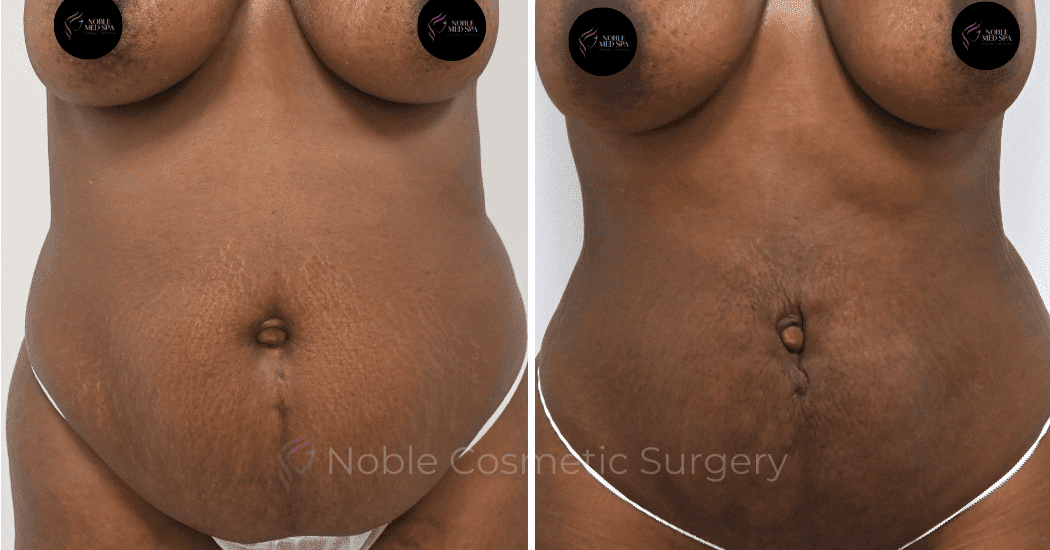 LIPOSUCTION-ABDOMEN-CASE-12901 | Before and After Body