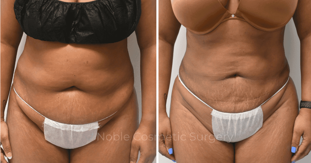 LIPOSUCTION-ABDOMEN-CASE-16787 | Before and After Body