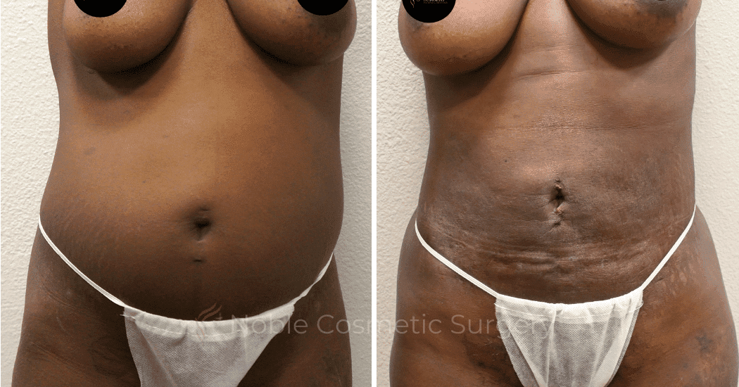 LIPOSUCTION-ABDOMEN-CASE-15104 | Before and After Body