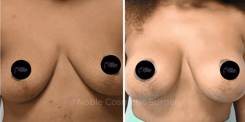 BREAST-AUGMENTATION-CASE-11356 | Before and After Breast