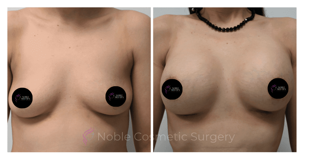 BREAST-AUGMENTATION-CASE-11661 | Before and After Breast