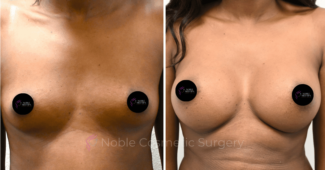 BREAST-AUGMENTATION-CASE-13251 | Before and After Breast