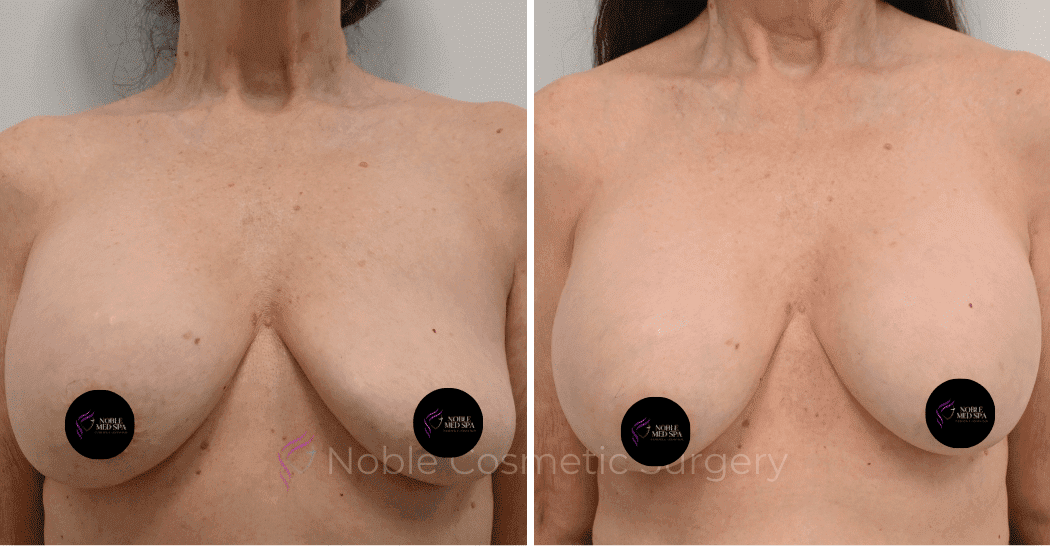 BREAST-AUGMENTATION-CASE-12085 | Before and After Breast