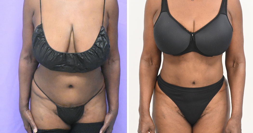 Case--19632 | Before and After Liposuction