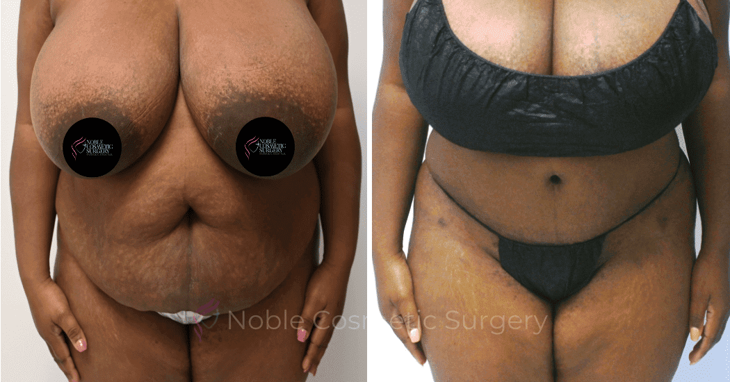TUMMY-TUCK-CASE-11720 | Before and After Body