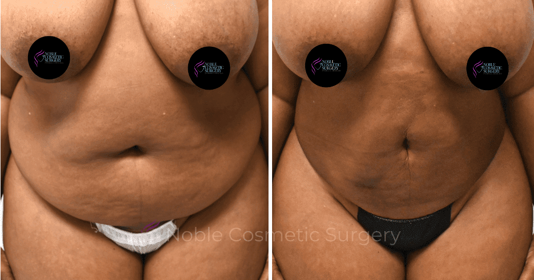LIPOSUCTION-CASE-13371 | Before and After Liposuction 1