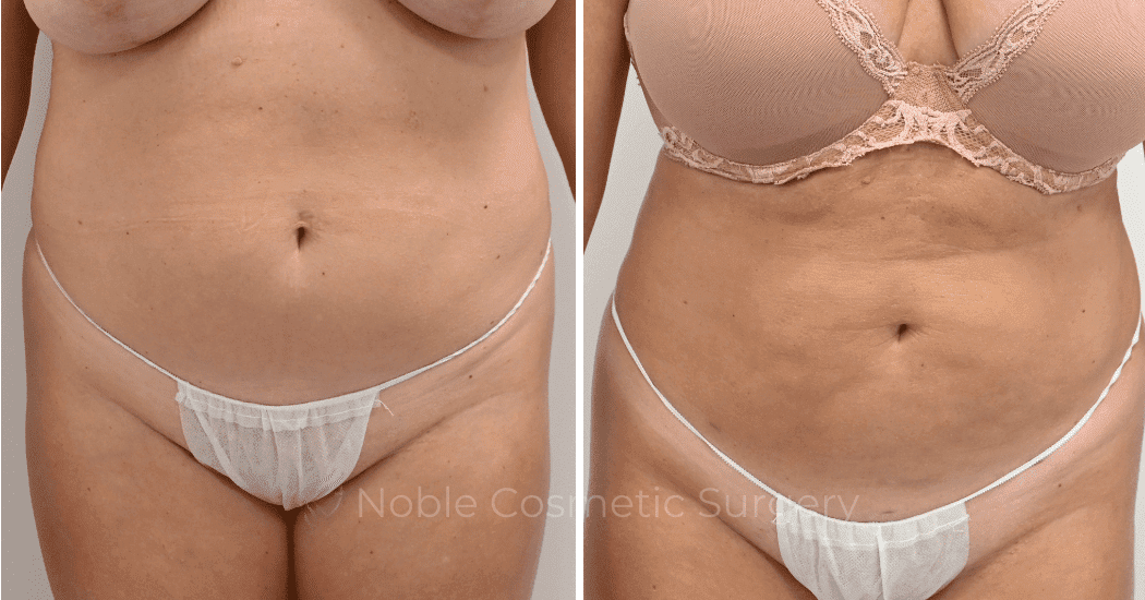 LIPOSUCTION-CASE-13006 | Before and After Liposuction 1